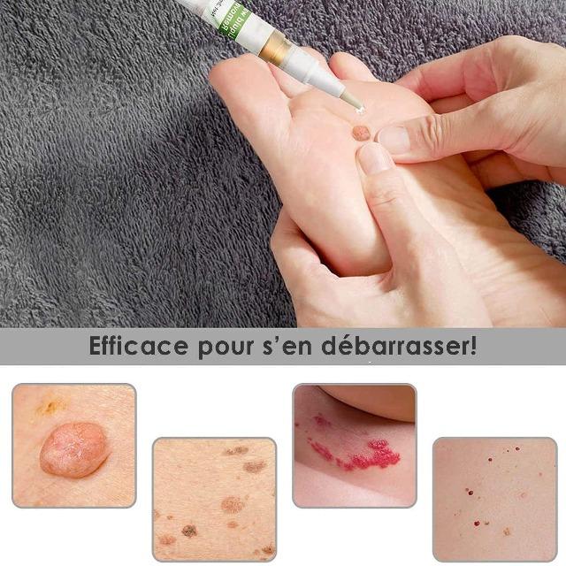 Gadgets d'Eve TAGFREE™ : Stylo Anti-Verrue